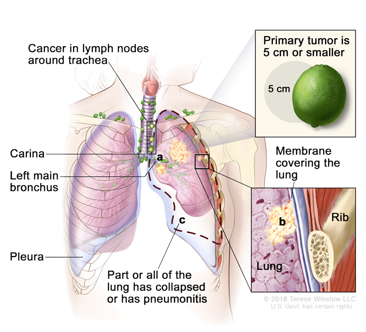 Stage 3 NonSmall Cell Lung Cancer Diagnosis XpertPatient