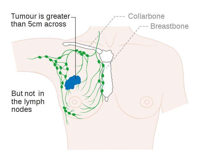 stage-2-breast-cancer-diagnosis-xpertpatient